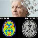 maladie d'Alzheimer