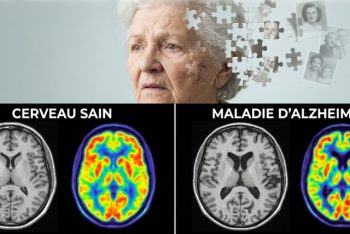 maladie d'Alzheimer